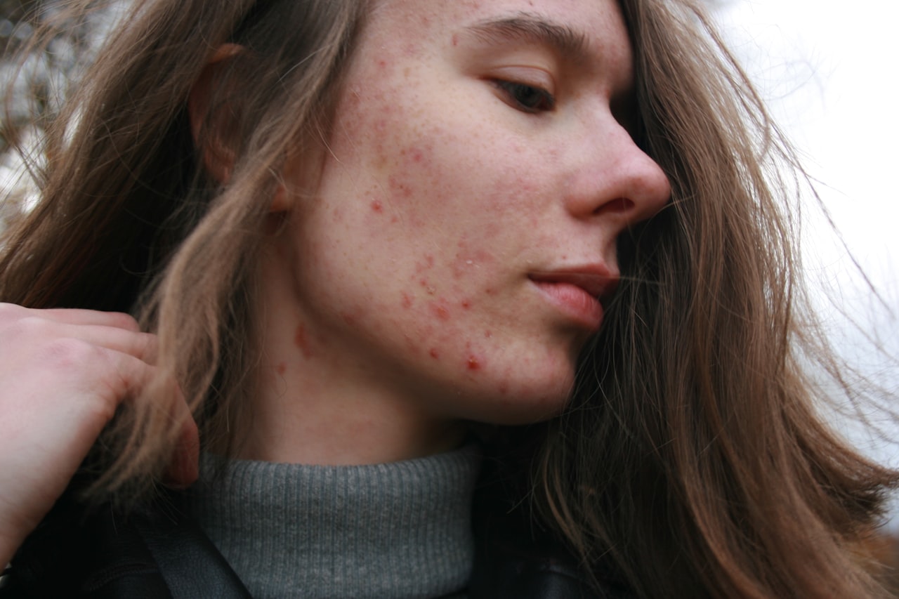 Acne & acne scarring — concern category