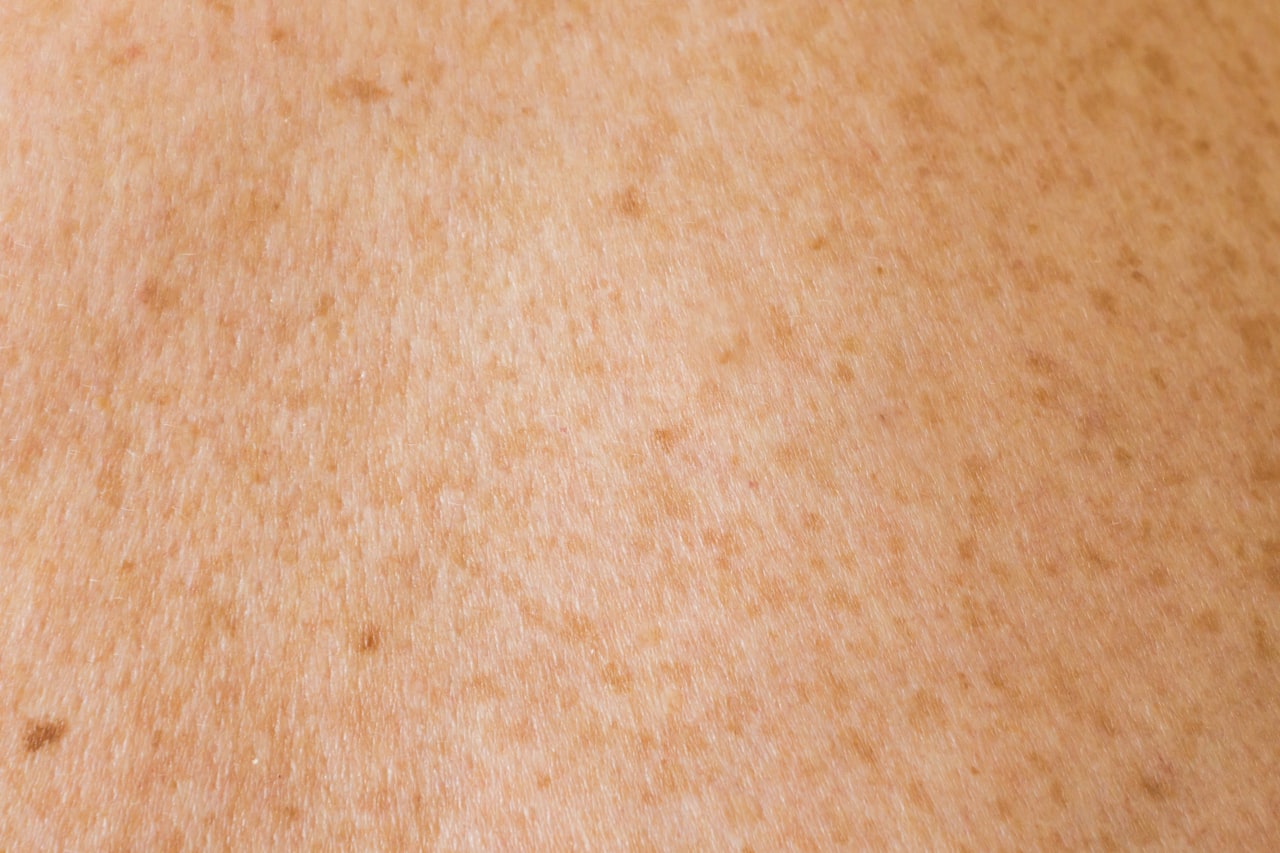 Stretch Marks — Body
