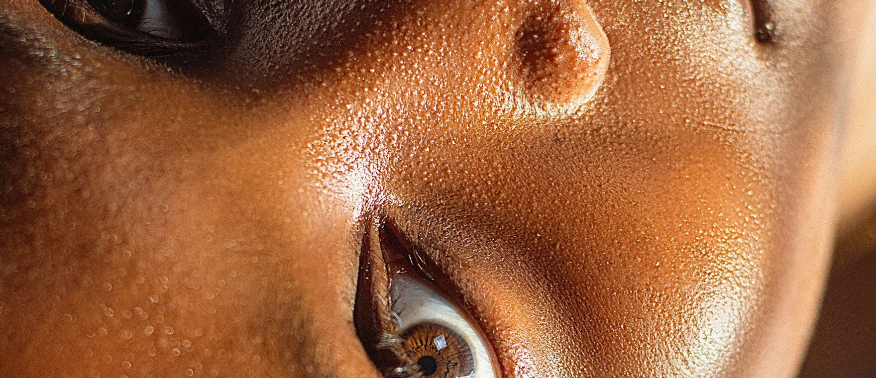 Profhilo® skin remodelling — skin treatment