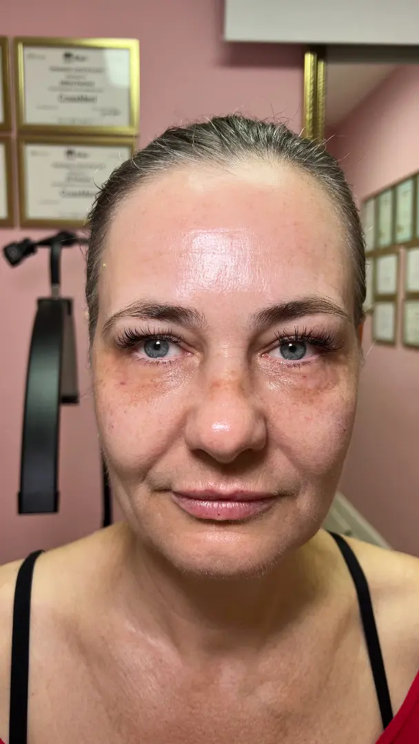 After — Facial Rebalancing and Under-Eye Restoration