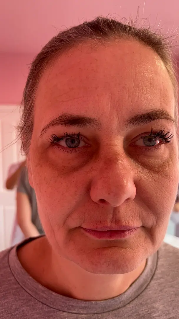 Before — Facial Rebalancing and Under-Eye Restoration