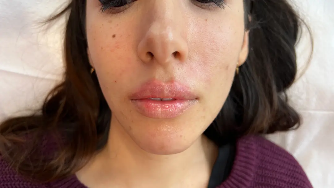 After — Natural Lip Enhancement