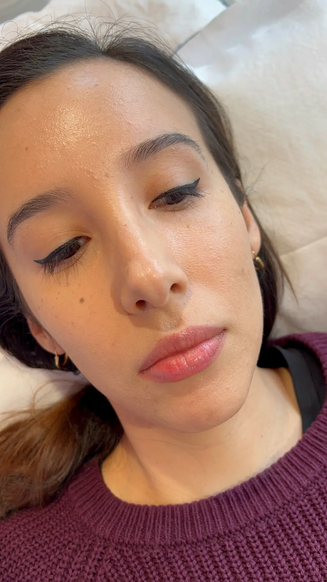 Before — Natural Lip Enhancement