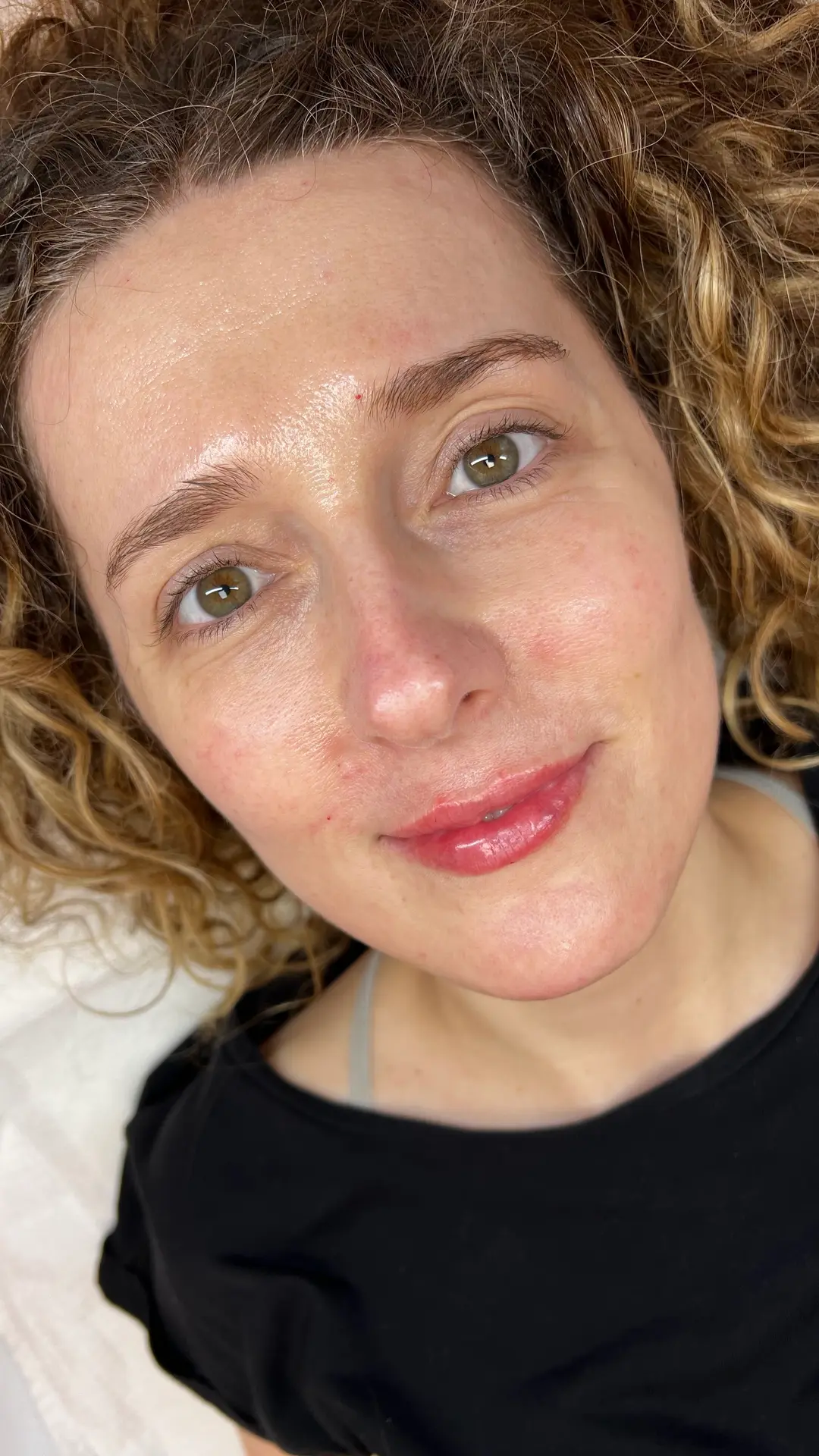 After — Natural Lip Enhancement