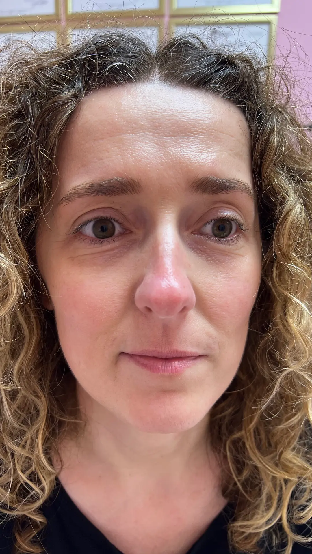 Before — Natural Lip Enhancement